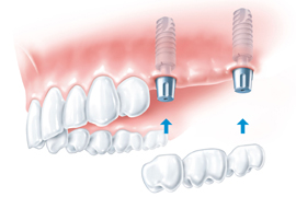 zobni implantant cenik