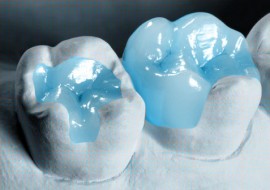 Dental-Inlays-Onlays
