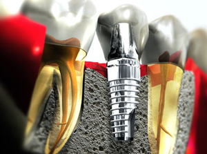 zobni implantanti