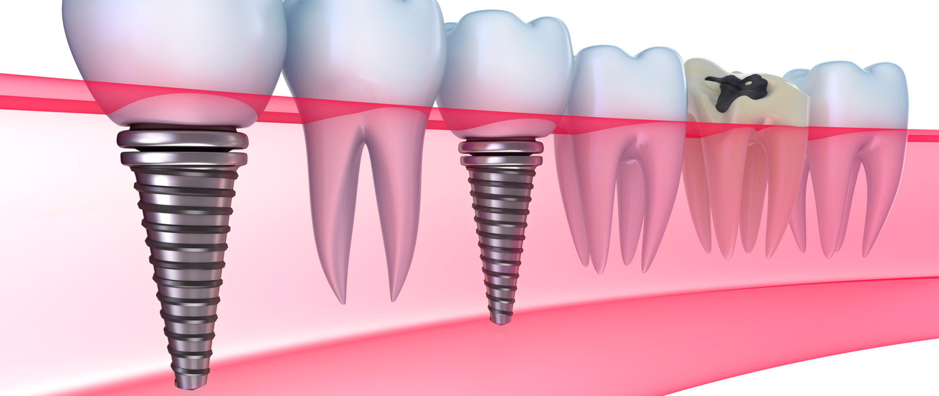 zobni implantat cena